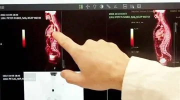 اكتشاف سعودي مثير: علاج جديد يدمر الخلايا السرطانية بالأشعة تحت الحمراء